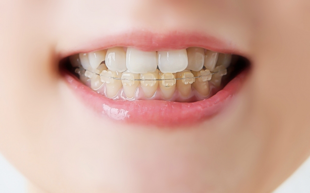 歯列矯正治療中に起きやすいトラブルとは？口内炎ができることも