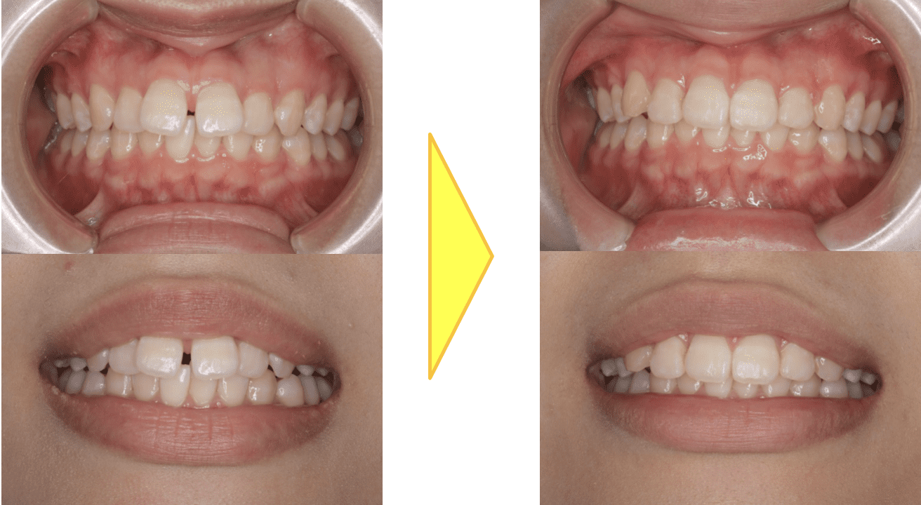 すきっ歯（空隙歯列）の症例写真