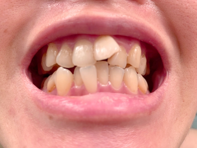 歯並びの悪さを放置するリスクとは？