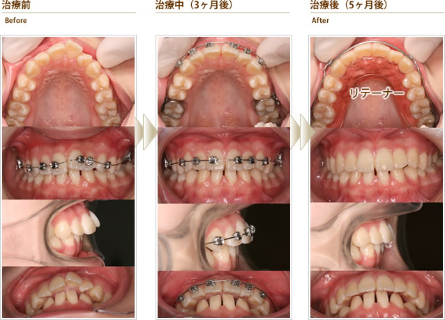 出っ歯を短期間で抜歯がなく、部分的に矯正して欲しい