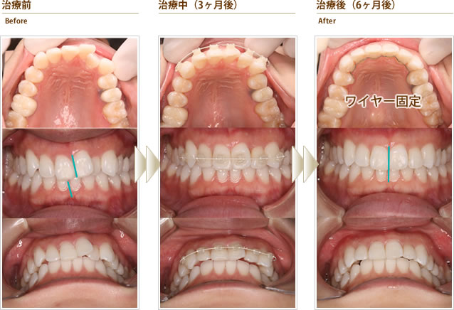 傾いた前歯と左右の八重歯（左上2本）がとくに気になる