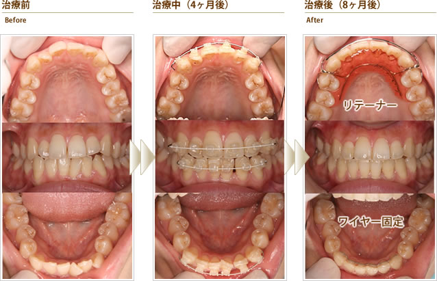 上下前歯部のガタガタ、とくに右上と左下のねじれている部分が気になる