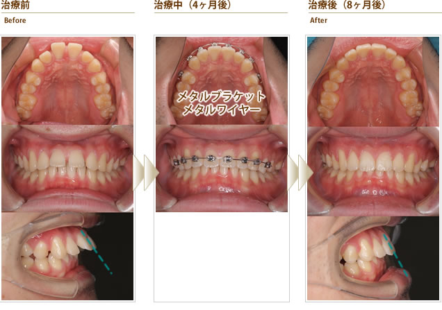 左上の前歯のすき間と下顎のガタガタが気になる